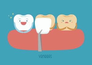 Porcelain Veneers Brisbane