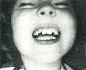 before porcelain veneers treatment