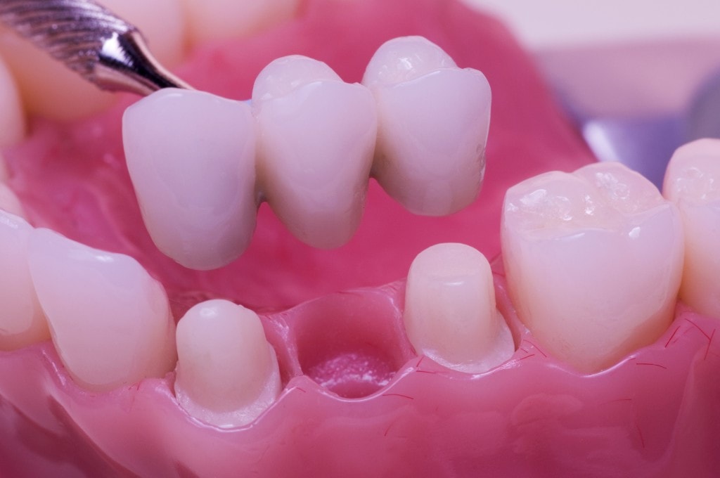 dental crowns and bridges