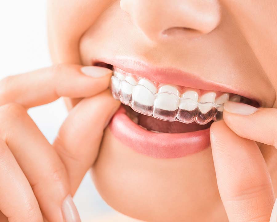 How to insert Invisalign aligners