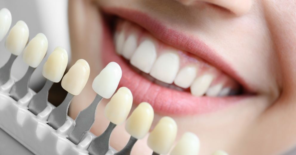 A person smiles behind a dental shade guide, curious: how much is it to whiten teeth?.