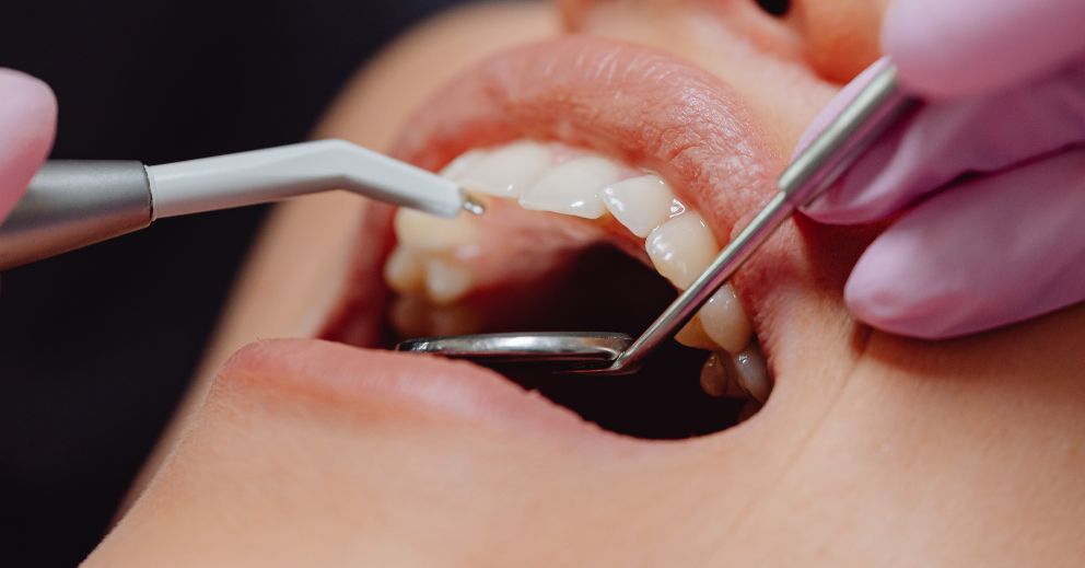 Close-up of a dental emergency examination with instruments inside a patient’s open mouth.