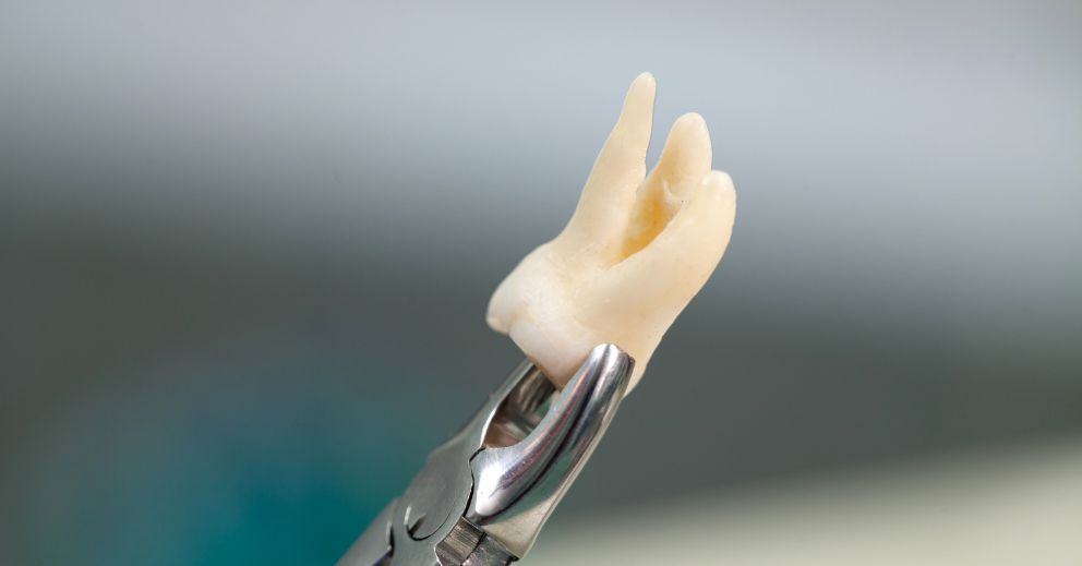 Extracted wisdom teeth surgery recovery time and held by dental forceps
