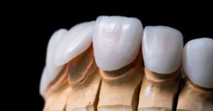 Close-up of dental crowns, highlighting porcelain vs composite veneers on a teeth model.