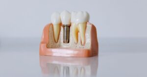 Dental Implants vs. Dentures: Model shows an implant tooth between two natural teeth on gums.