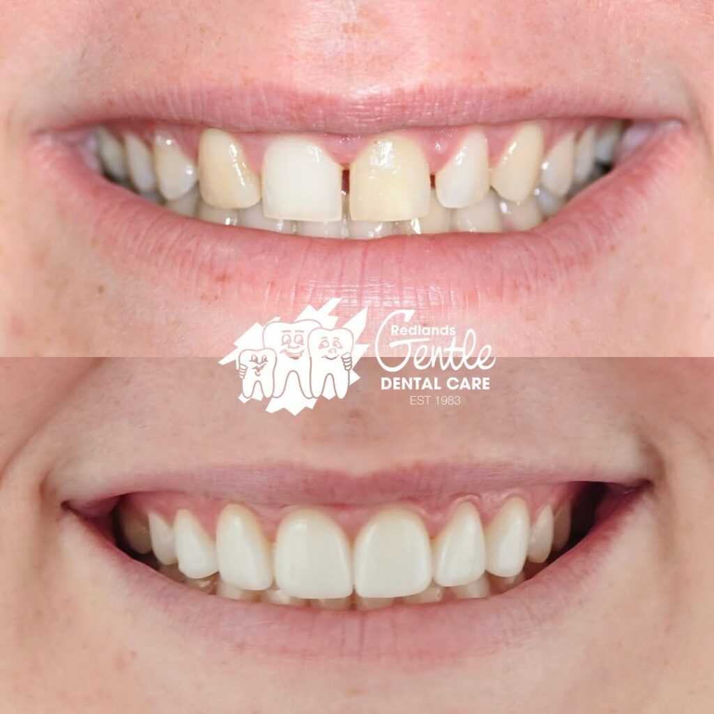 Before and after dental treatment smiling teeth