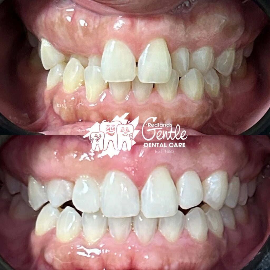 Teeth before and after dental care treatment.