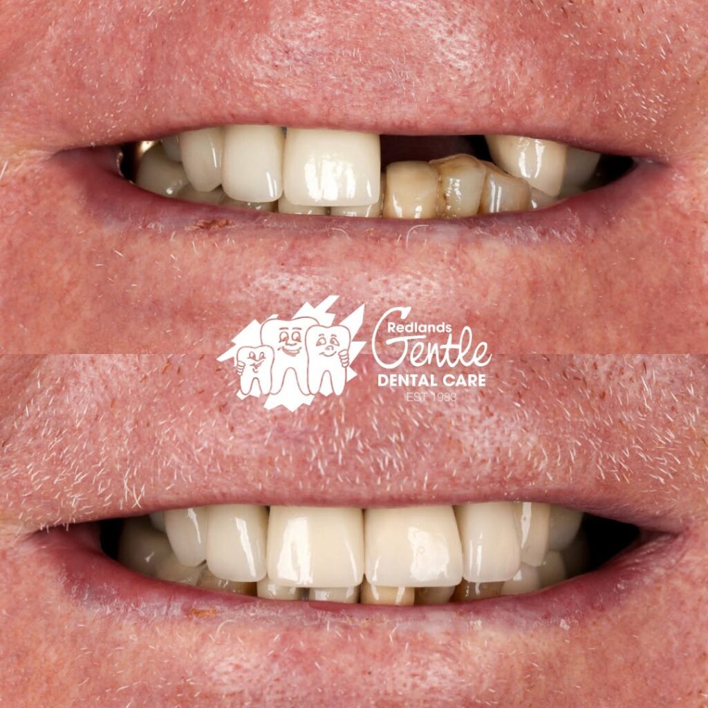 Before and after dental treatment comparison.
