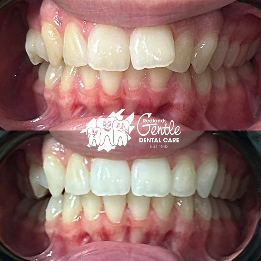 Before and after dental cleaning comparison