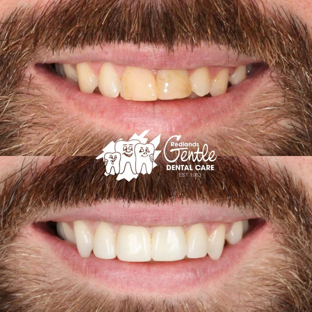 Before and after dental whitening treatment.