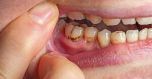 Close-up of teeth and gums showing dental plaque, tartar build-up, and tooth decay in children.