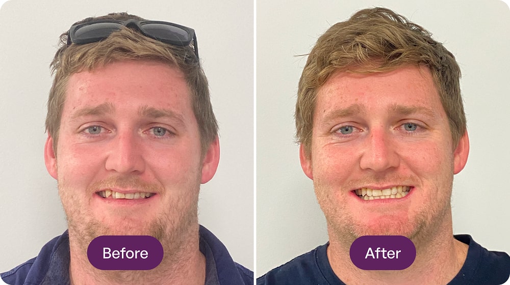 Before and after teeth whitening transformation.