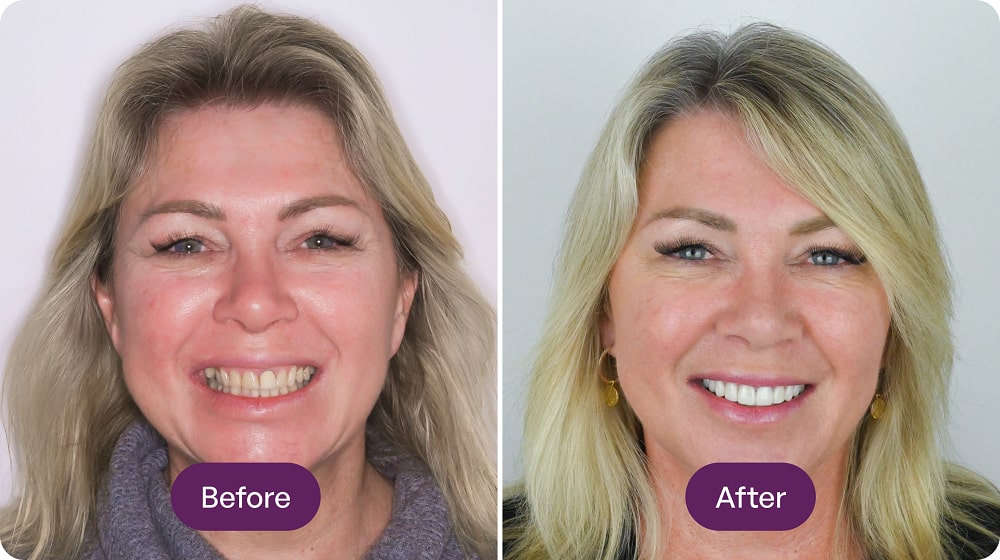 Woman's smile transformation: before and after comparison.