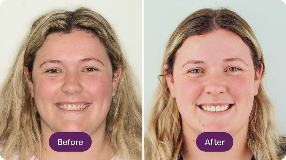 Before and after smiling woman comparison photo.