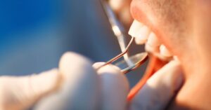 Close-up of a dentist checking teeth, highlighting dental check-up cost Victoria Point.