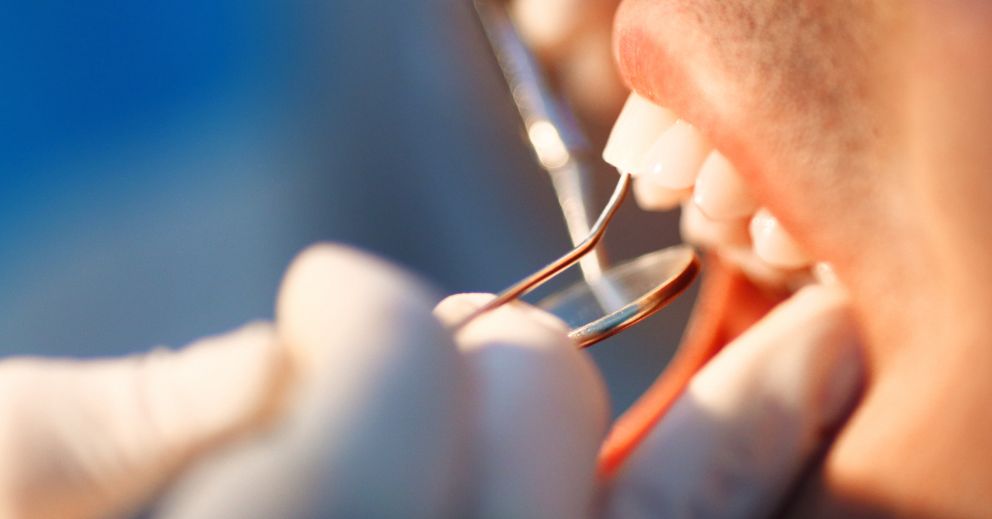 Close-up of a dentist checking teeth, highlighting dental check-up cost Victoria Point.