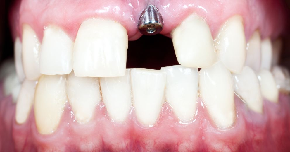 Close-up of teeth with a missing upper front tooth and a dental implant that feels wobbly.