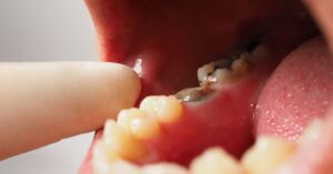 Close-up of visible tooth decay on a back tooth