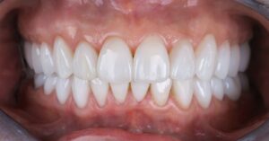 Close-up of dental veneers showing common issues that may require correction