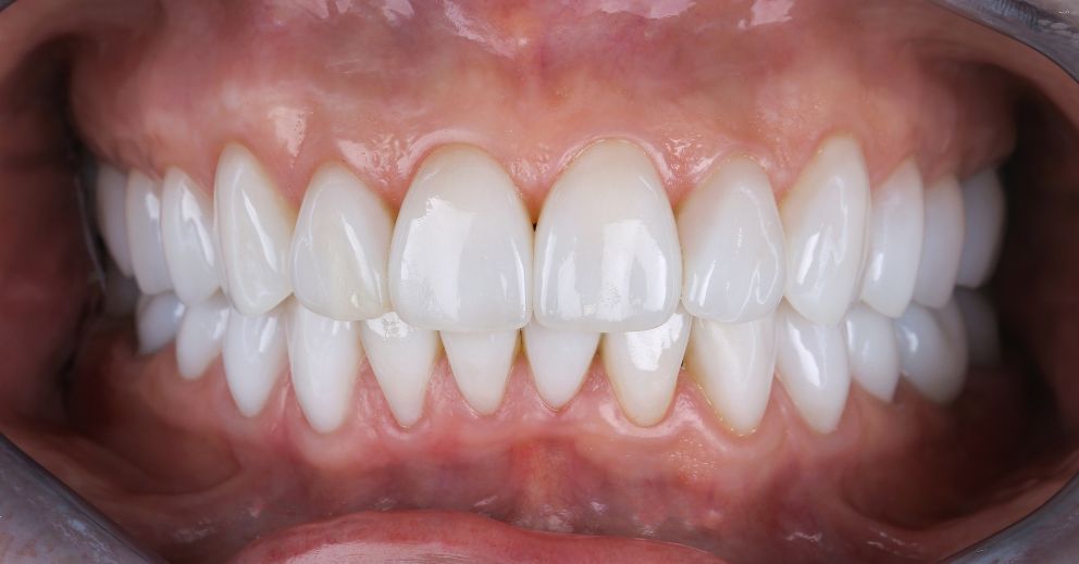Close-up of dental veneers showing common issues that may require correction