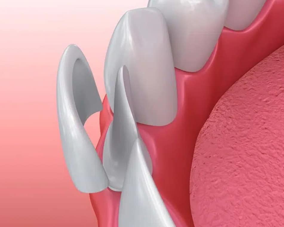 Illustration of how Porcelain Veneers are applied