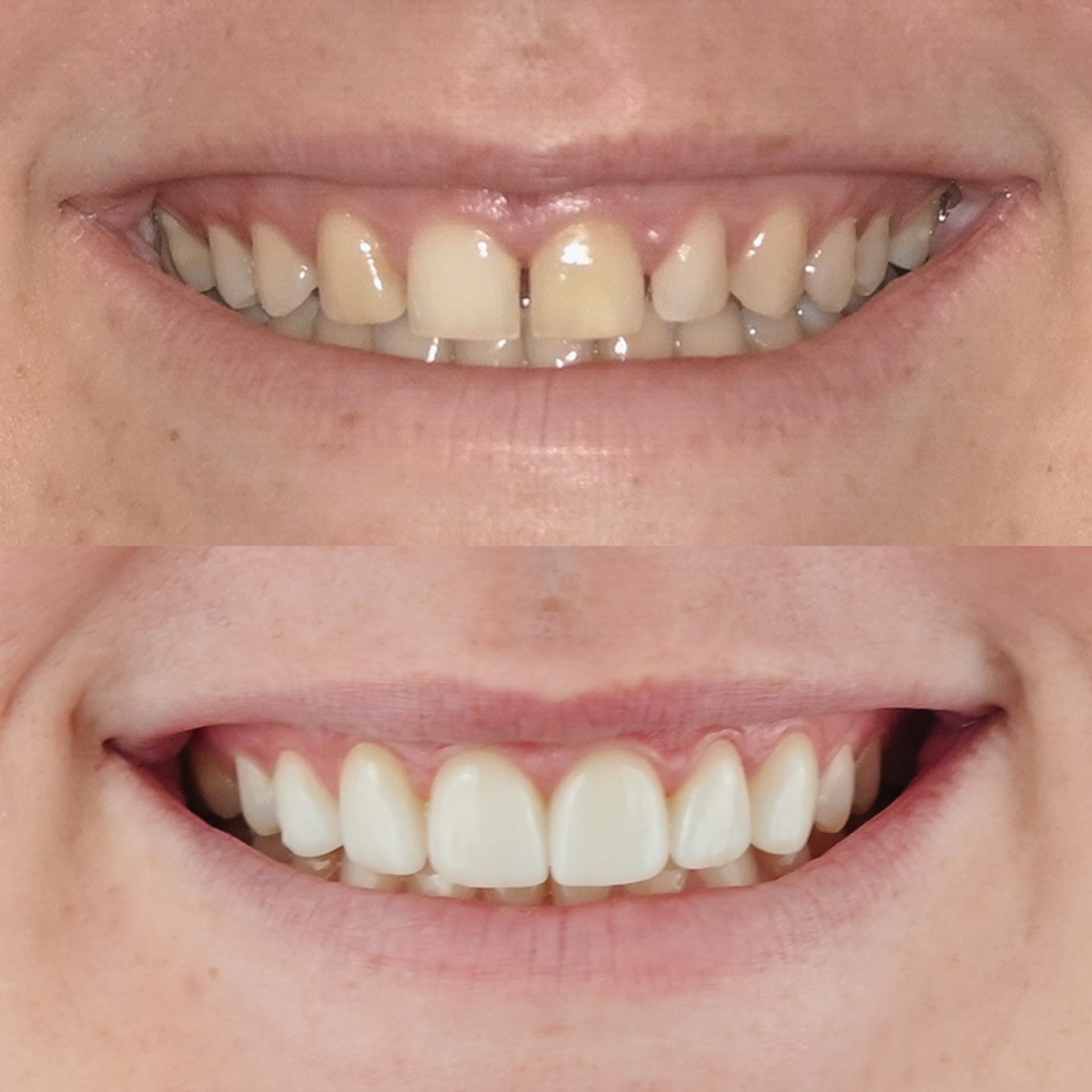 Veneer Case Teeth Dentist Capalaba & Victoria Point