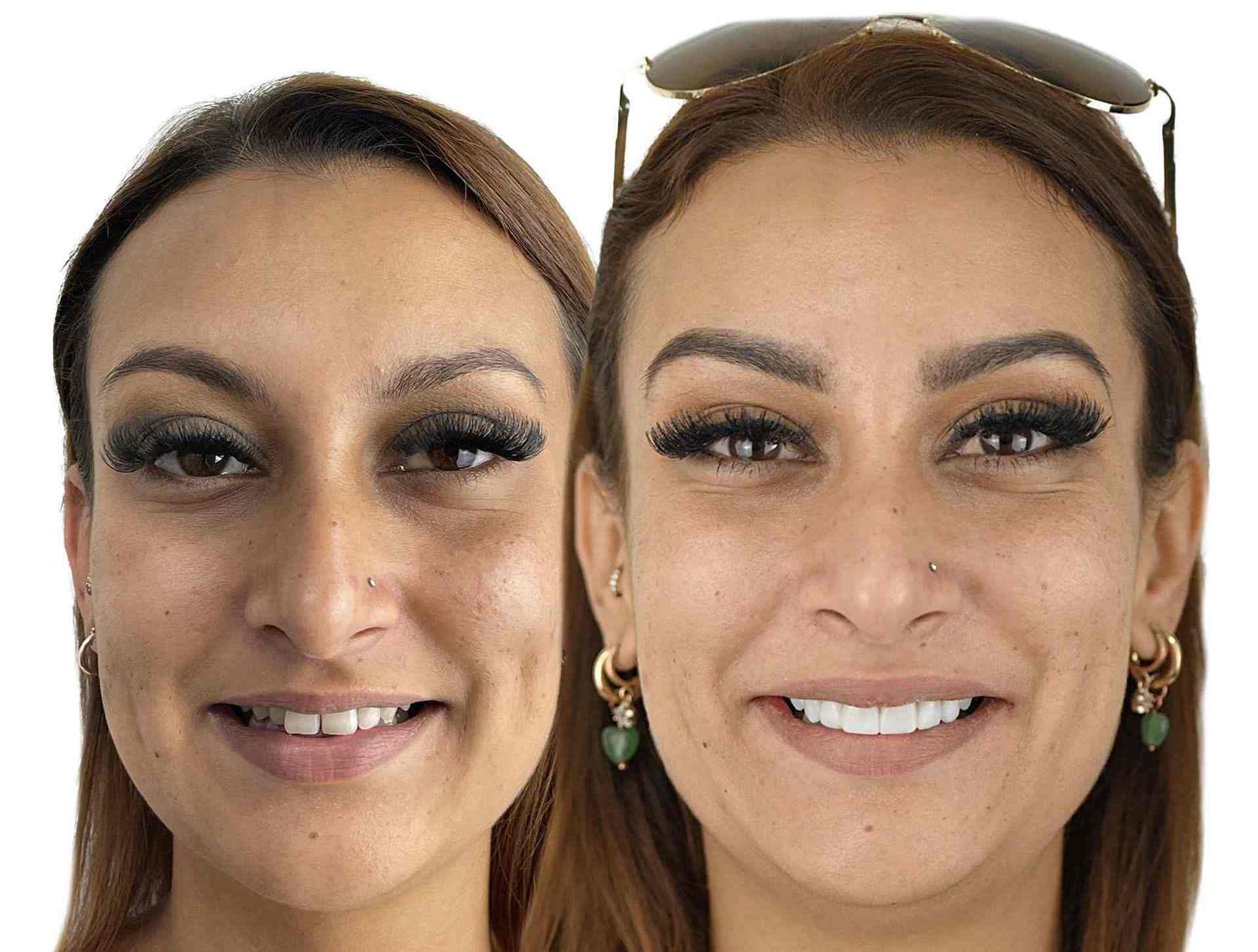 Before & after results from veneers in Brisbane