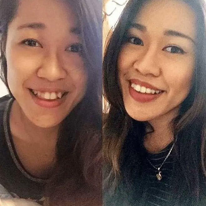 Before & after results from Invisalign
