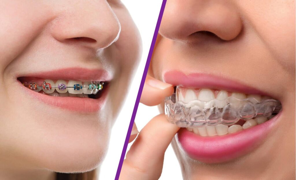 Invisalign compared to braces